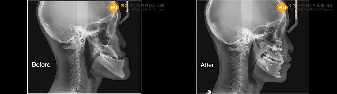 ก่อนและหลัง ผ่าตัดขากรรไกร