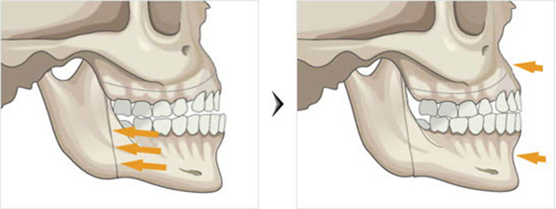 ผ่าตัดเลื่อนขากรรไกร โรงพยาบาล อียู