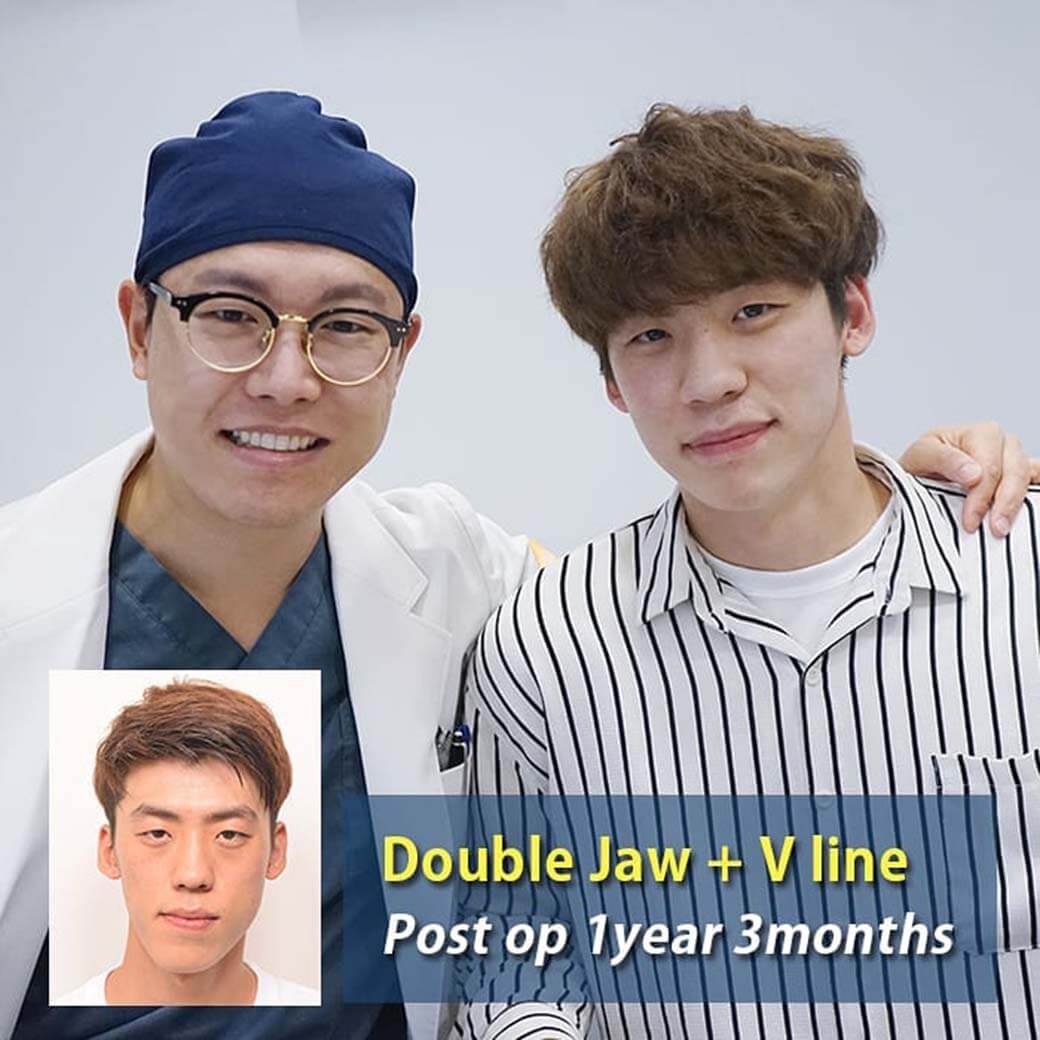 รีวิว Double Jaw V line 1 ผู้ชาย